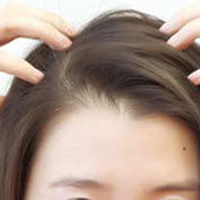 如何预防脱发 女性经常脱发怎么治呢?